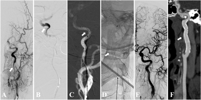 Initial clinical experience with Xpert-Pro peripheral self-expanding stent system for internal carotid artery dissection: Two case reports