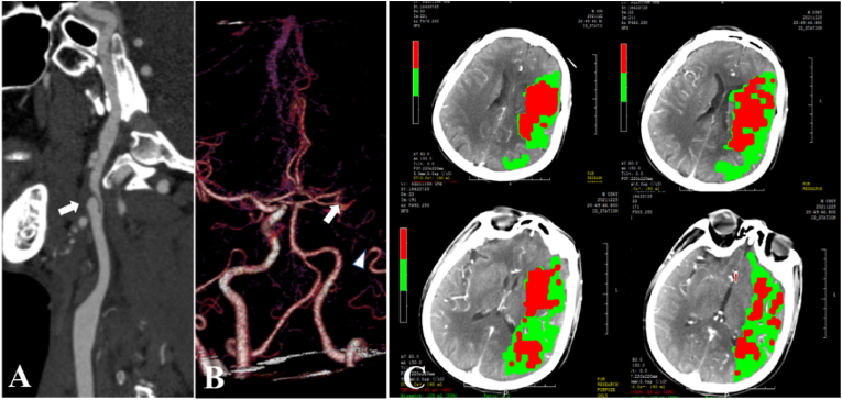 Initial clinical experience with Xpert-Pro peripheral self-expanding stent system for internal carotid artery dissection: Two case reports