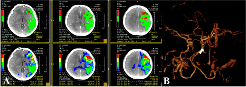 Initial clinical experience with Xpert-Pro peripheral self-expanding stent system for internal carotid artery dissection: Two case reports