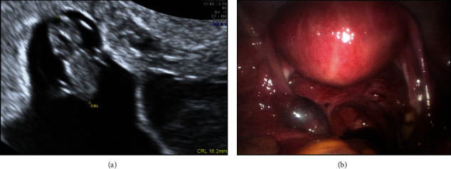 Heterotopic Pregnancy: Case Series and Review of Diagnosis and Management.