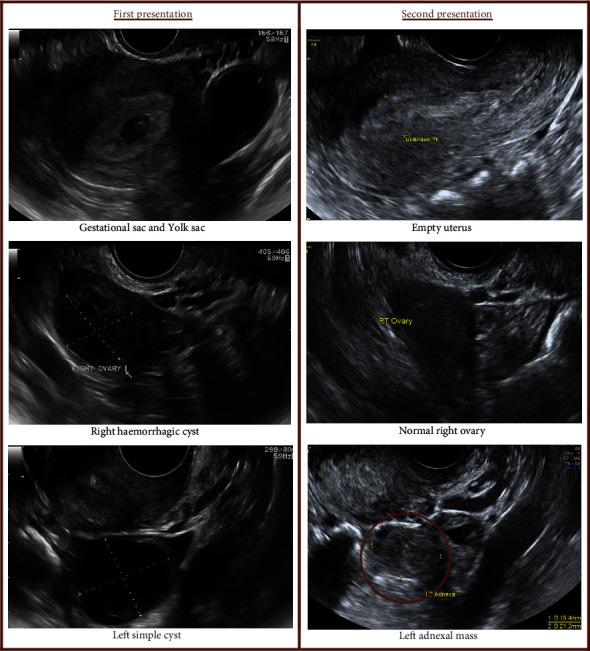 Heterotopic Pregnancy: Case Series and Review of Diagnosis and Management.