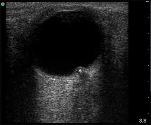 Ultrasound detected increase in optic disk height to identify elevated intracranial pressure: a systematic review.