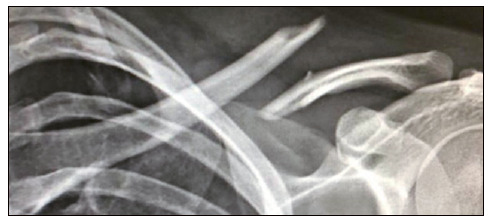 MINIMALLY INVASIVE OSTEOSYNTHESIS FOR CLAVICULAR FRACTURE WITH LOCKED PLATE.