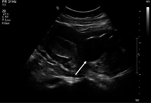 Cervical Ripening Balloon in Combination with Methotrexate and Potassium Chloride for the Treatment of a 13-week Cervical Ectopic Pregnancy.