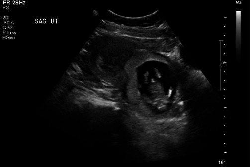 Cervical Ripening Balloon in Combination with Methotrexate and Potassium Chloride for the Treatment of a 13-week Cervical Ectopic Pregnancy.