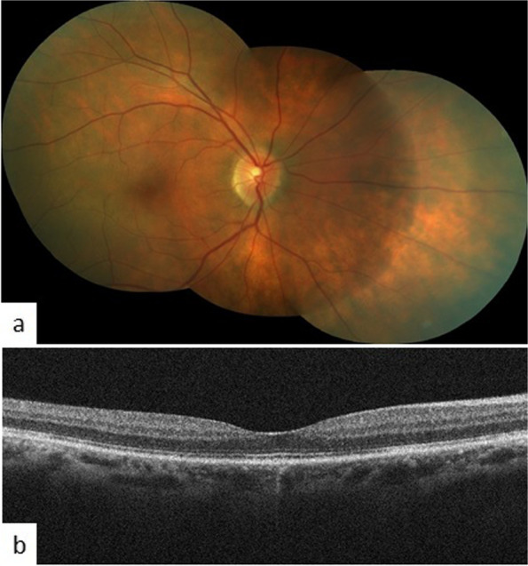 An atypical presentation of sympathetic ophthalmia following chemical ocular burns.