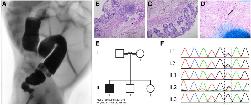 A Novel <i>ANO1</i> Gene Variant is Associated with Intestinal Dysmotility Syndrome Masquerading as Hirschsprung Disease: A Case Report.