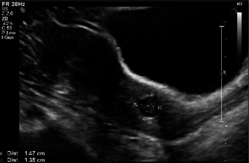 Cervical Ripening Balloon in Combination with Methotrexate and Potassium Chloride for the Treatment of a 13-week Cervical Ectopic Pregnancy.