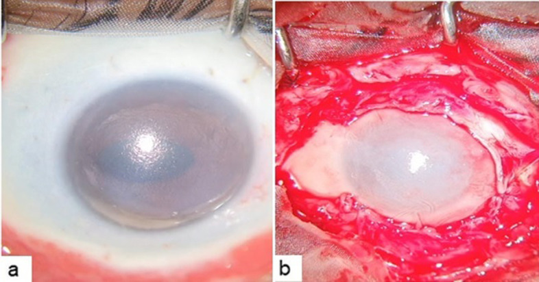 An atypical presentation of sympathetic ophthalmia following chemical ocular burns.