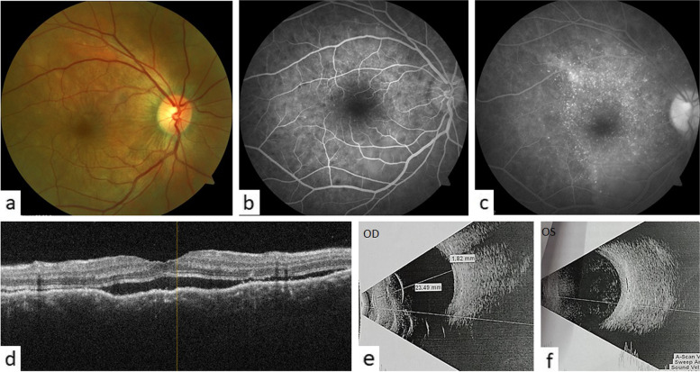 An atypical presentation of sympathetic ophthalmia following chemical ocular burns.