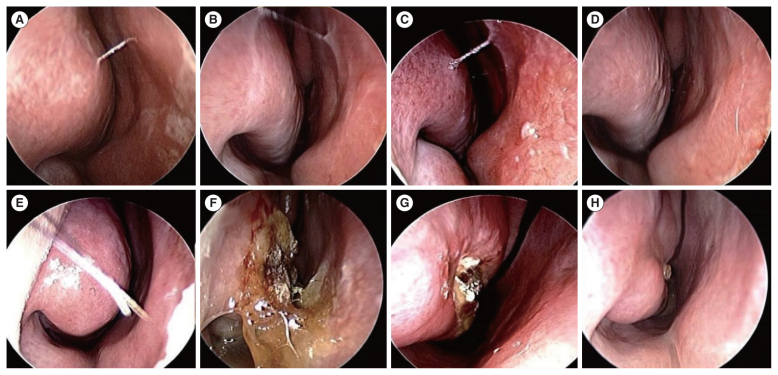 High-Intensity Focused Ultrasound Therapy Versus Coblation for the Treatment of Inferior Turbinate Hypertrophy: A Clinical Trial.