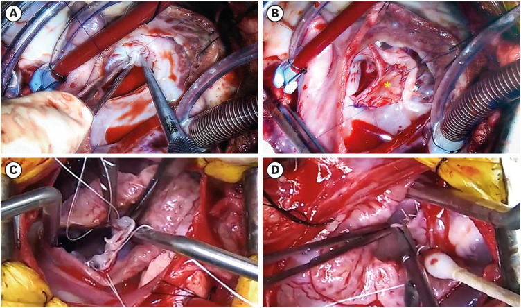 Open-heart surgery using Del-Nido cardioplegia in two dogs: partial atrioventricular septal defect and mitral repair.