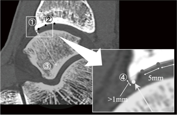 Relationship between the morphology of osteophytes and cartilage lesions in anterior ankle impingement in athletes: a cross-sectional study.