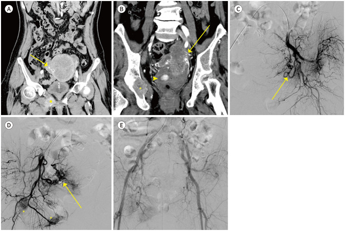 Transcatheter Arterial Embolization for Palliation of Uterine Body Cancer Bleeding.