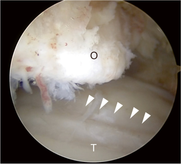 Relationship between the morphology of osteophytes and cartilage lesions in anterior ankle impingement in athletes: a cross-sectional study.