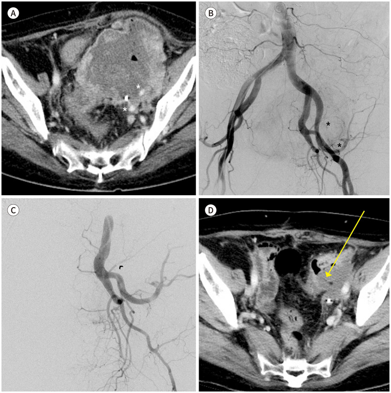 Transcatheter Arterial Embolization for Palliation of Uterine Body Cancer Bleeding.