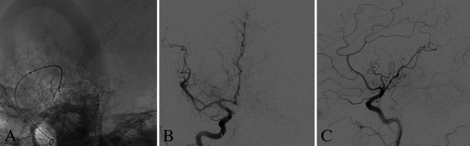 Endovascular treatment of a ruptured pure arterial malformation and associated dysplastic middle cerebral artery dissecting aneurysm: illustrative case.