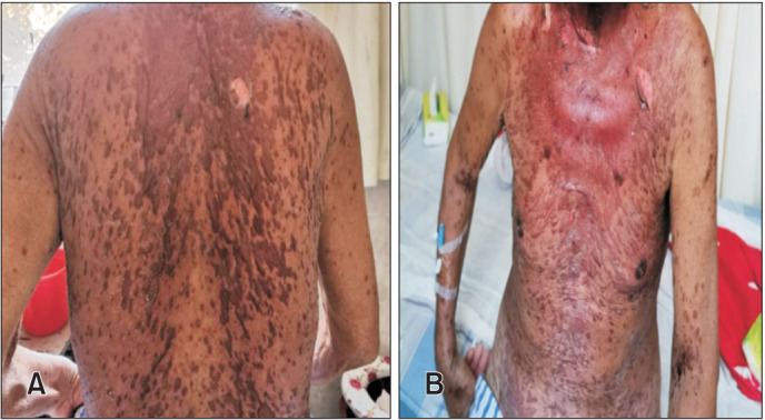 Toxic Epidermal Necrolysis Induced by Sintilimab: A Case Report.