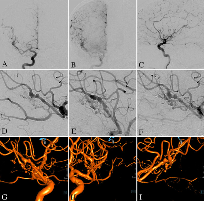 Endovascular treatment of a ruptured pure arterial malformation and associated dysplastic middle cerebral artery dissecting aneurysm: illustrative case.