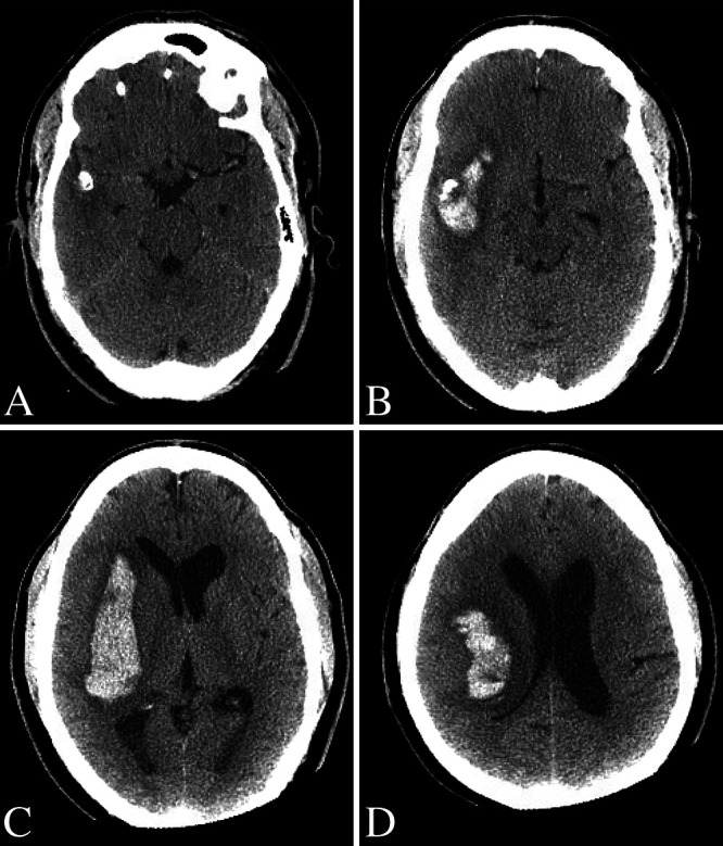 Endovascular treatment of a ruptured pure arterial malformation and associated dysplastic middle cerebral artery dissecting aneurysm: illustrative case.