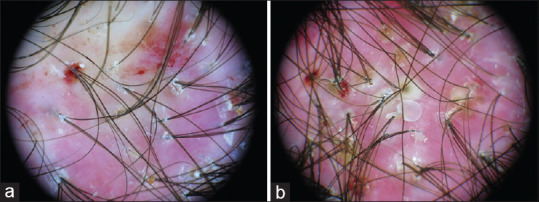Comment on Topical Dapsone for Folliculitis Decalvans.