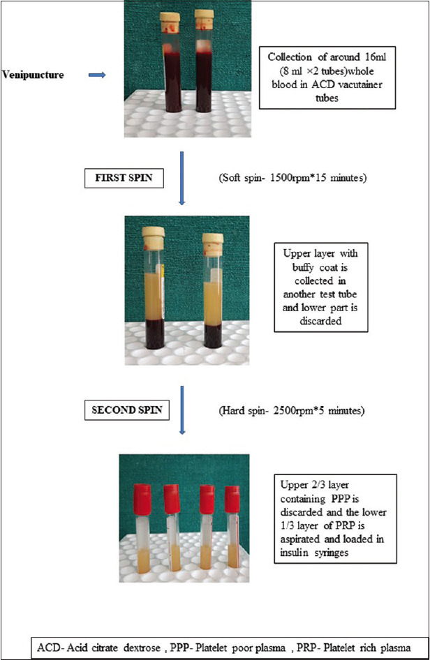 Platelet-Rich Plasma in Androgenetic Alopecia: Is It Really Worth the Hype?