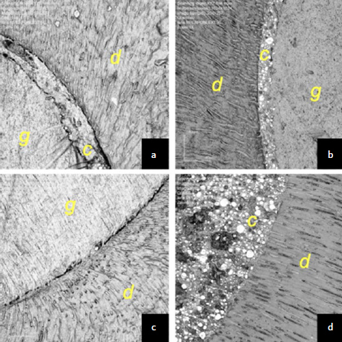 Effect of Carbodiimide (EDC) on the Bond Strength Longevity of Epoxy Resin-based Endodontic Sealer to Root Dentin: An In-Vitro Study.