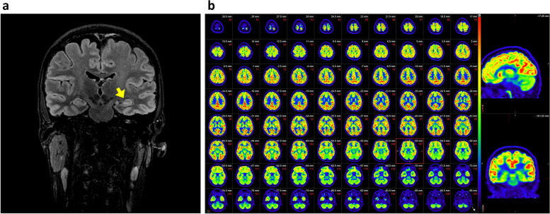 De novo ADGRV1 variant in a patient with ictal asystole provides novel clues for increased risk of SUDEP.