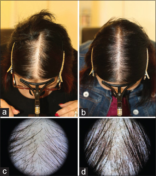 Efficacy, Tolerability, and Superiority of Propylene Glycol-Free, North American Witch-Hazel (<i>Hamamelis virginiana</i>)-Based Solution of 5% Minoxidil Sulfate for the Treatment of Female Androgenetic Alopecia.