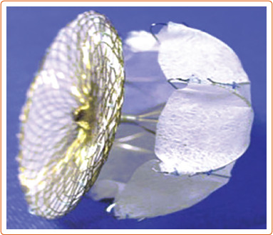 Transcatheter Left Atrial Appendage Closure: Devices Available, Pitfalls, Advantages, and Future Directions.