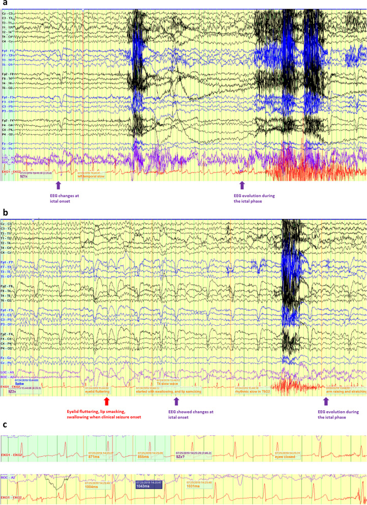 De novo ADGRV1 variant in a patient with ictal asystole provides novel clues for increased risk of SUDEP.