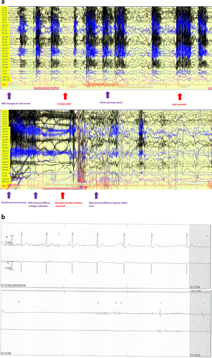 De novo ADGRV1 variant in a patient with ictal asystole provides novel clues for increased risk of SUDEP.