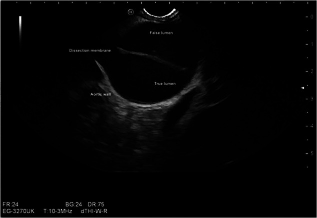 The role of endosonography in cardiology: case series and literature review.
