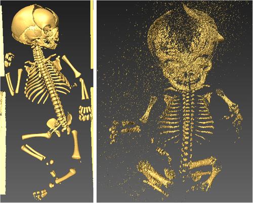 The distal femoral epiphysis used as a fetal maturity marker: Implications of extant medical data for bioarcheological analysis