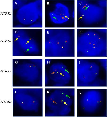 NTRK gene aberrations in triple-negative breast cancer: detection challenges using IHC, FISH, RT-PCR, and NGS