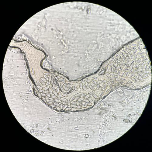 Enterobiasis in the hospitalized patient