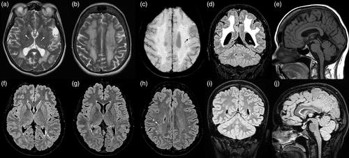 Spectrum of white matter abnormalities associated with FOXC1-related disorders in two unrelated cases