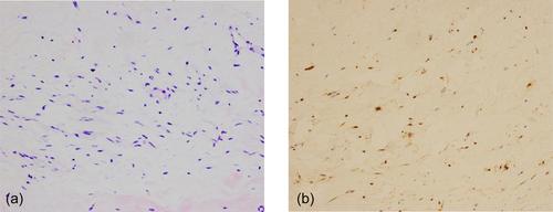 A case report of multimodal ultrasound imaging in the diagnosis of giant retroperitoneal ganglioneuroma