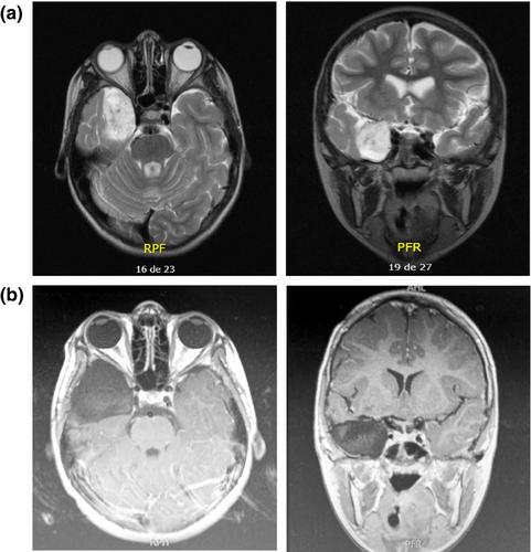 Partial Klüver–Bucy syndrome in a Paediatric patient: A post-neurosurgical and neuropsychological cases