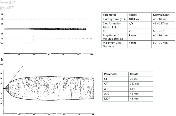 Treating Acquired Factor VIII Inhibitor and Tumor-Induced Hypoglycemia in a Case of Relapsed Diffuse Large B-Cell Lymphoma.