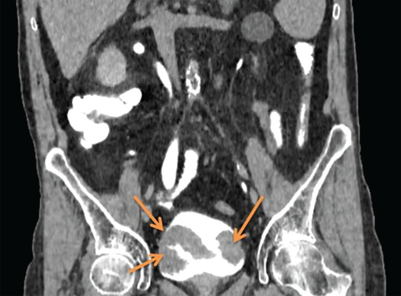 Urinary Bladder Carcinoma Demonstrated on Bone Scintigraphy and SPECT/CT Images.