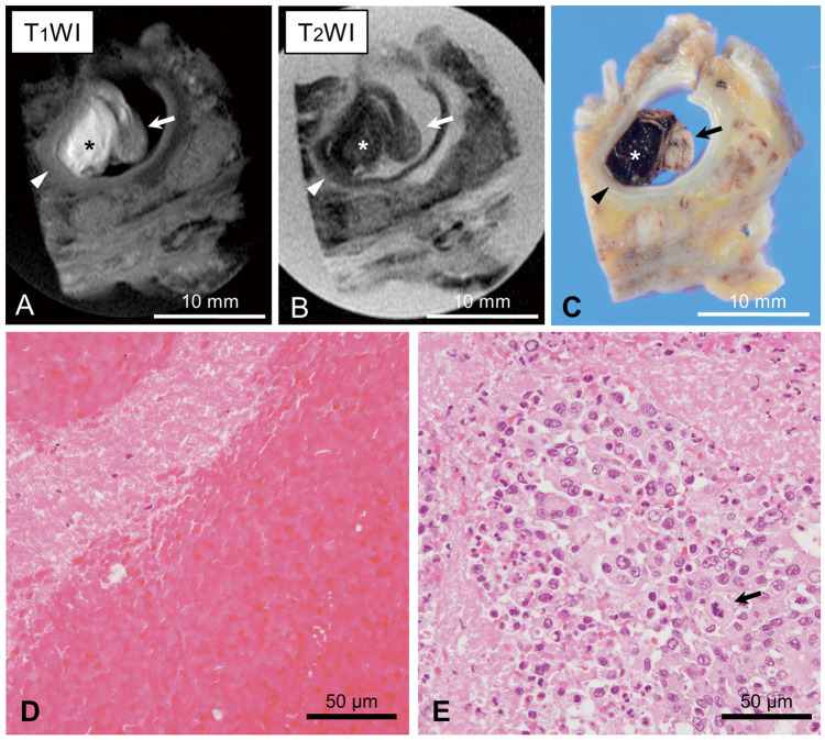 Magnetic Resonance Imaging of Cancer-Associated Deep Vein Thrombus in a Patient With Gastric Cancer.