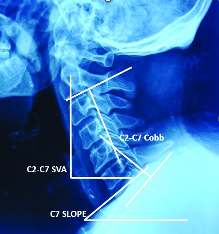 Influence of Preoperative Sagittal Alignment on Functional Recovery in Operated Cases of Cervical Spondylotic Myelopathy.