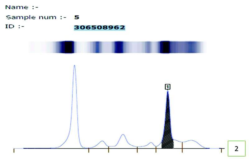 Twin Malignancy of Acute Myeloid Leukemia and Multiple Myeloma in a Chemotherapy-Naïve Patient: A Rare Occurrence.