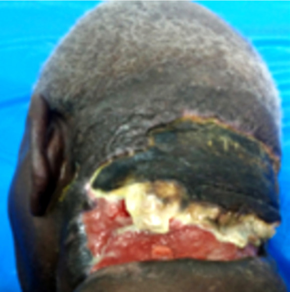 [Necrotizing fasciitis of the posterior neck. A rare clinical form of head and neck cellulitis: a case report from Togo].