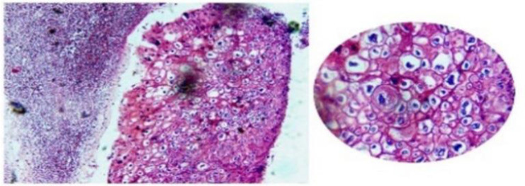 Histopathological characteristics and HPV status in cervical biopsy specimens diagnosed as flat condyloma.