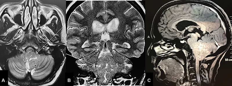 Adult Brainstem Astroblastoma: Unusual Presentation of a Rare Tumor.