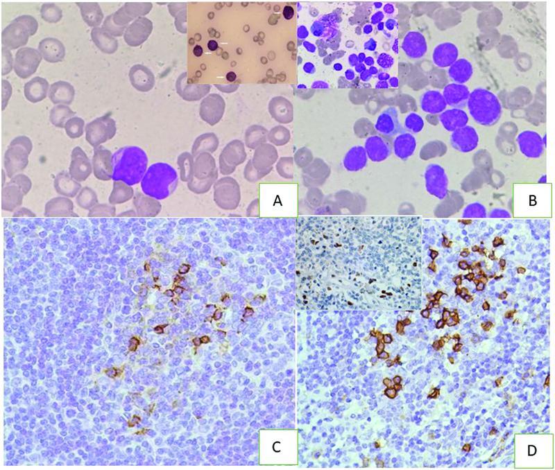 Twin Malignancy of Acute Myeloid Leukemia and Multiple Myeloma in a Chemotherapy-Naïve Patient: A Rare Occurrence.