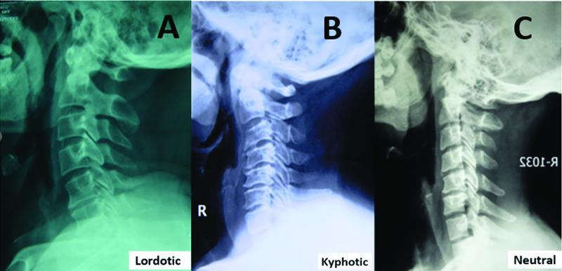 Influence of Preoperative Sagittal Alignment on Functional Recovery in Operated Cases of Cervical Spondylotic Myelopathy.