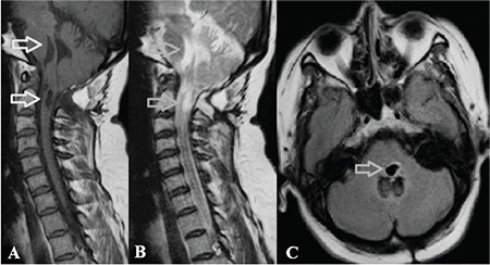 A Rare Case Report of Eight Syndrome Secondary to Syringomyelia Associated with Type I Chiari Malformation.